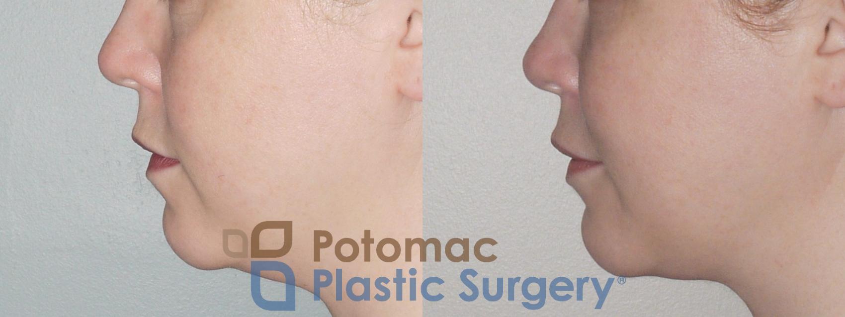 Before & After Neck Lift Case 87 Left Side View in Washington, DC