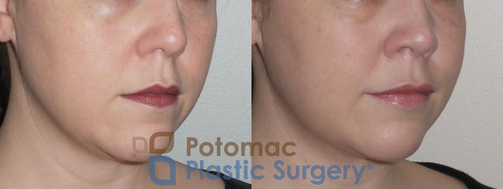 Before & After Neck Lift Case 87 Right Oblique View in Washington DC & Arlington , DC