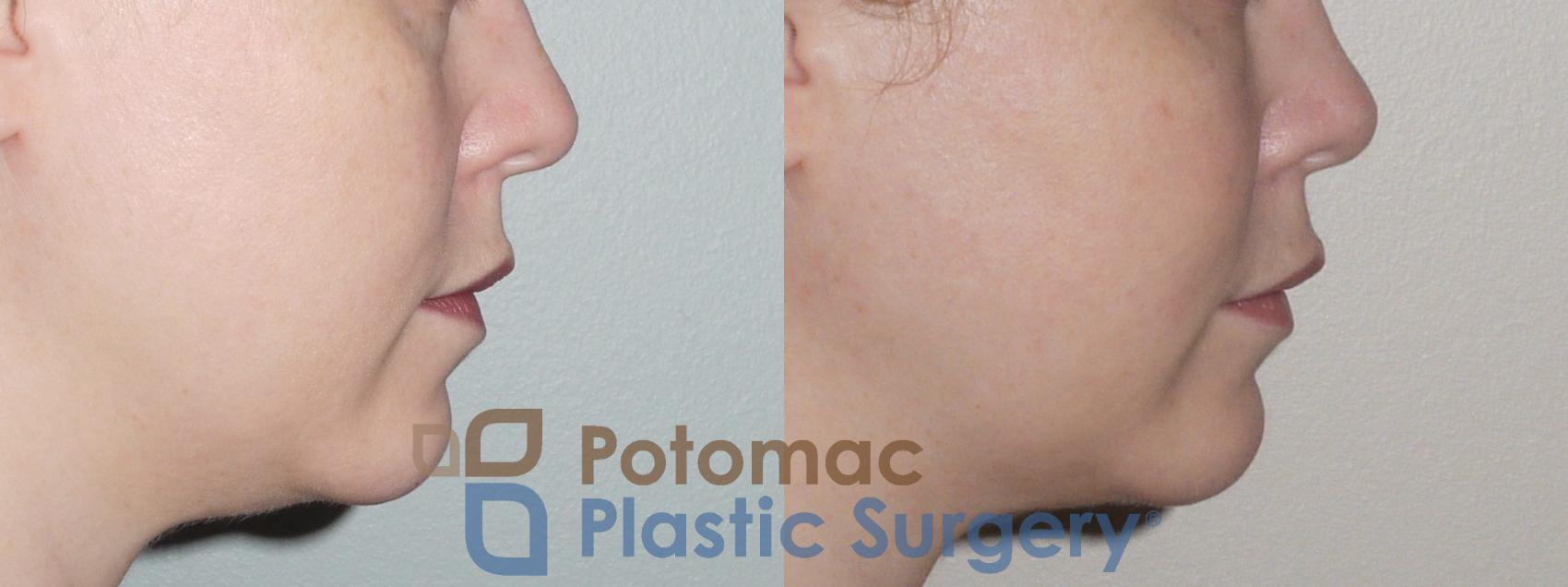 Before & After Neck Lift Case 87 Right Side View in Washington, DC