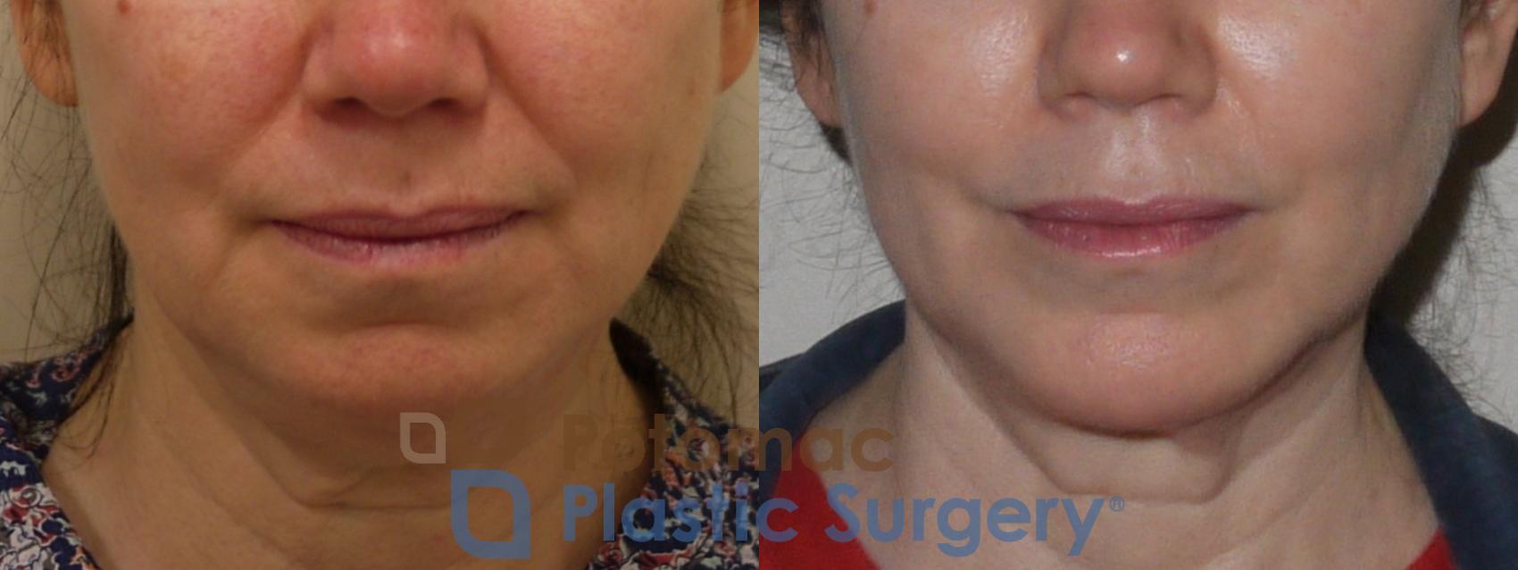 Before & After Neck Lift Case 96 Front View in Washington, DC