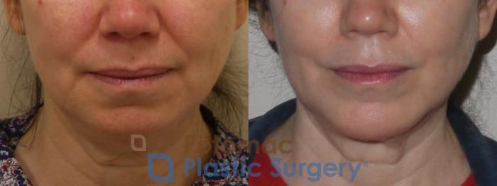 Before & After Liposuction Case 96 Front View in Washington DC & Arlington , DC
