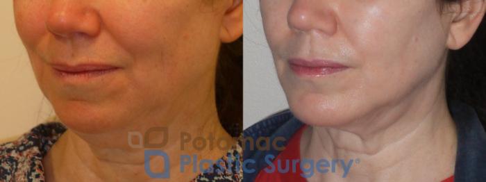 Before & After Liposuction Case 96 Left Oblique View in Washington DC & Arlington , DC