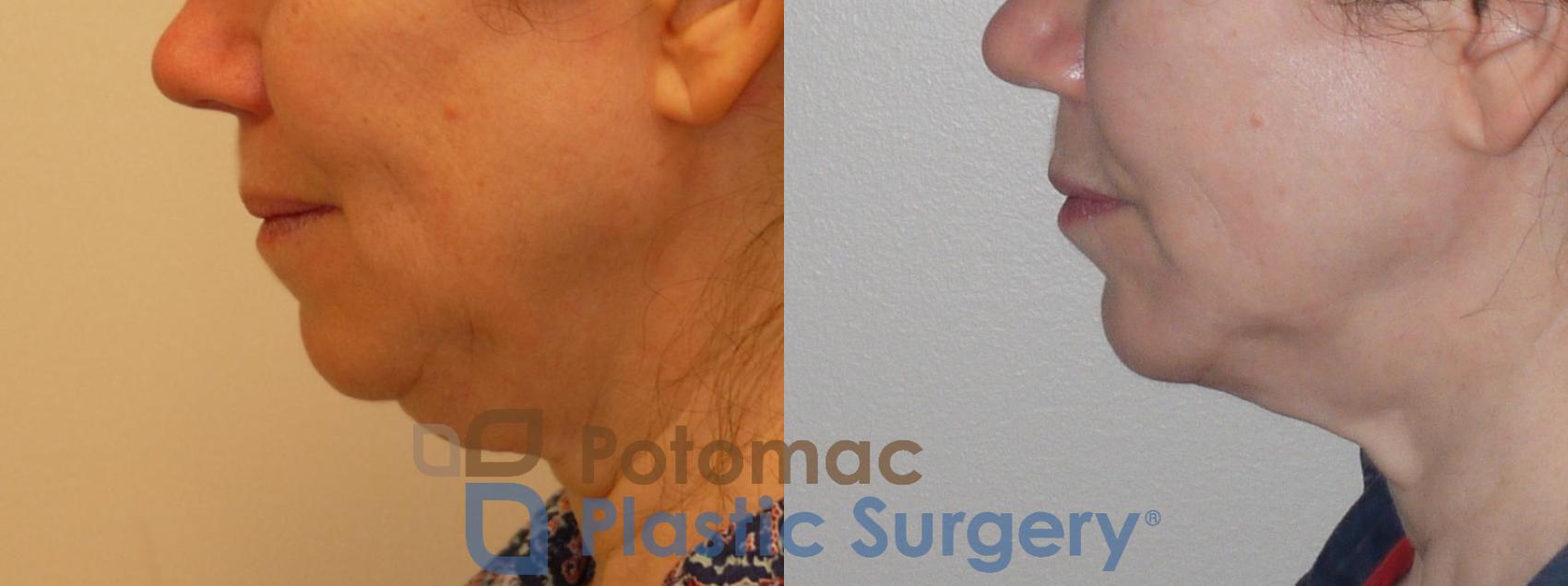 Before & After Neck Lift Case 96 Left Side View in Washington, DC