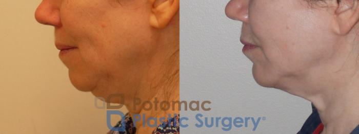 Before & After Liposuction Case 96 Left Side View in Washington DC & Arlington , DC