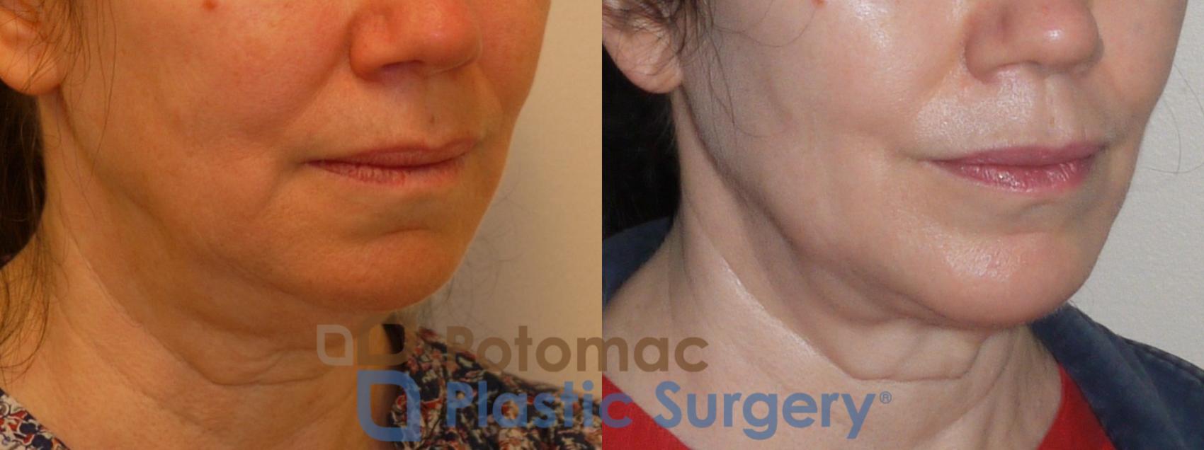Before & After Neck Lift Case 96 Right Oblique View in Washington, DC