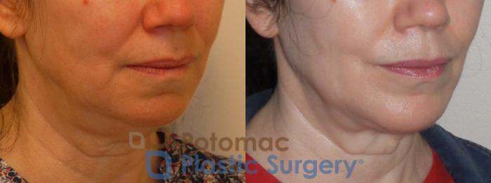 Before & After Liposuction Case 96 Right Oblique View in Washington DC & Arlington , DC