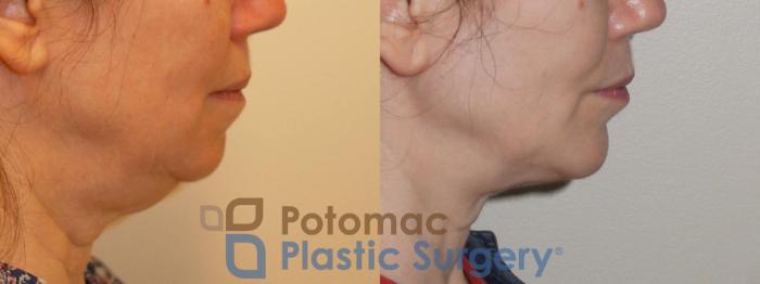 Before & After Chin Augmentation Case 96 Right Side View in Washington, DC