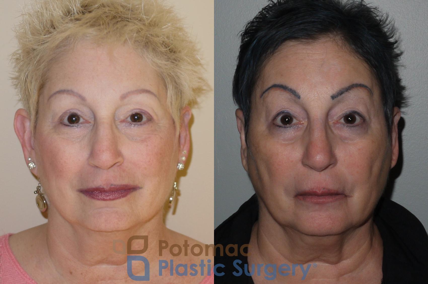 Before & After Otoplasty Case 101 Front View in Washington, DC