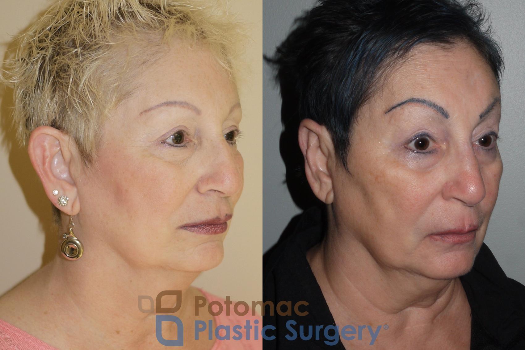 Before & After Otoplasty Case 101 Right Oblique View in Washington, DC