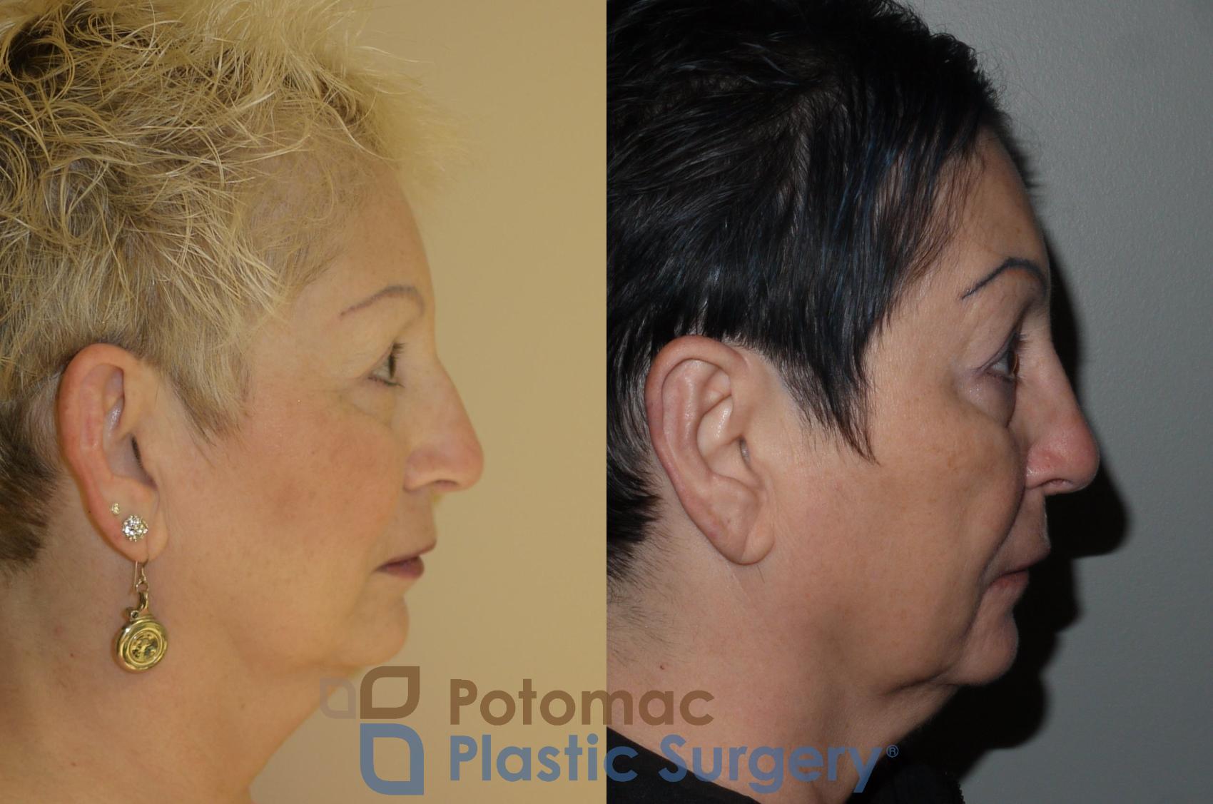 Before & After Otoplasty Case 101 Right Side View in Washington, DC