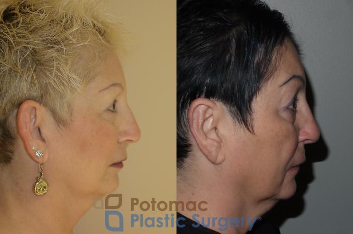 Before & After Otoplasty Case 101 Right Side View in Washington DC & Arlington , DC