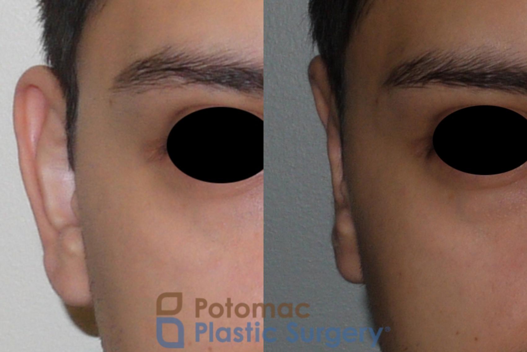 Before & After Otoplasty Case 113 Front View in Washington, DC