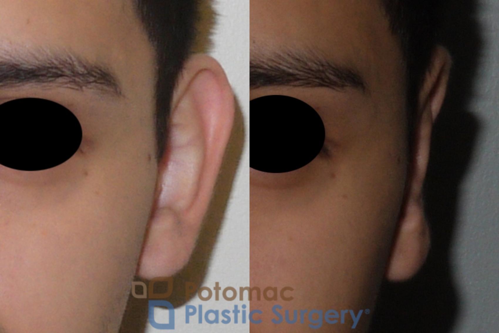 Before & After Otoplasty Case 113 Front View #2 View in Washington, DC