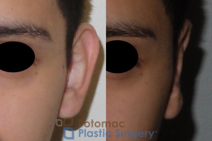 Before & After Otoplasty Case 113 Front View #2 View in Washington DC & Arlington , DC
