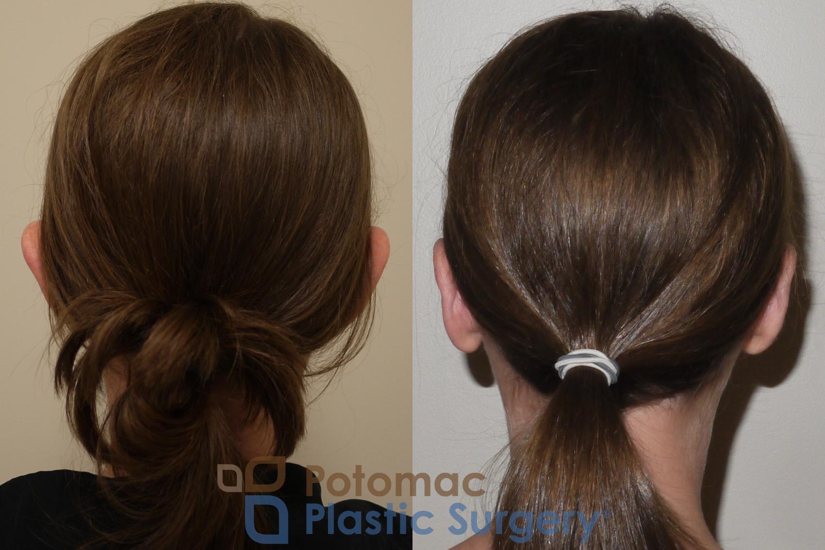 Before & After Otoplasty Case 150 Back View in Washington DC & Arlington , DC