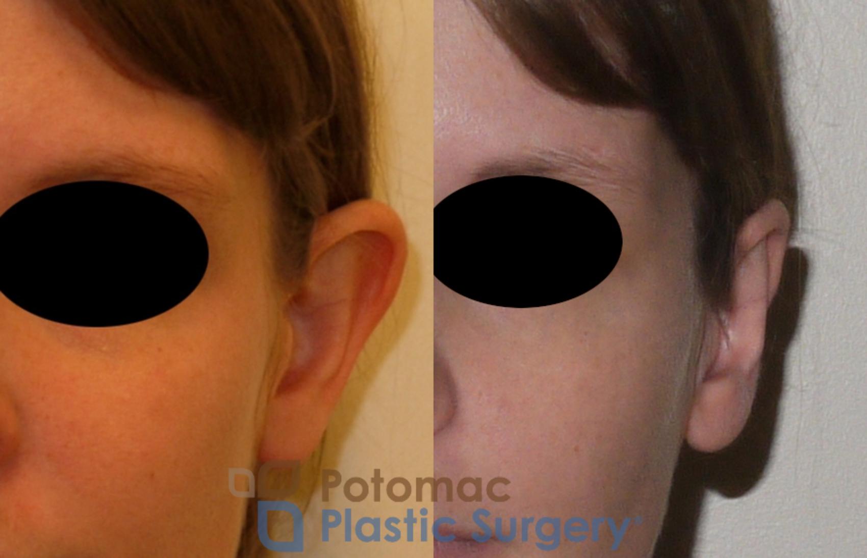 Before & After Otoplasty Case 150 Front View #1 View in Washington, DC