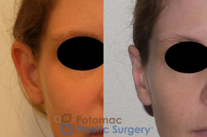 Before & After Otoplasty Case 150 Front View #2 View in Washington DC & Arlington , DC
