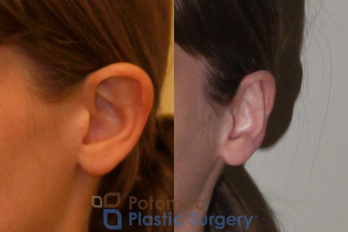 Before & After Otoplasty Case 150 Left Oblique View in Washington DC & Arlington , DC