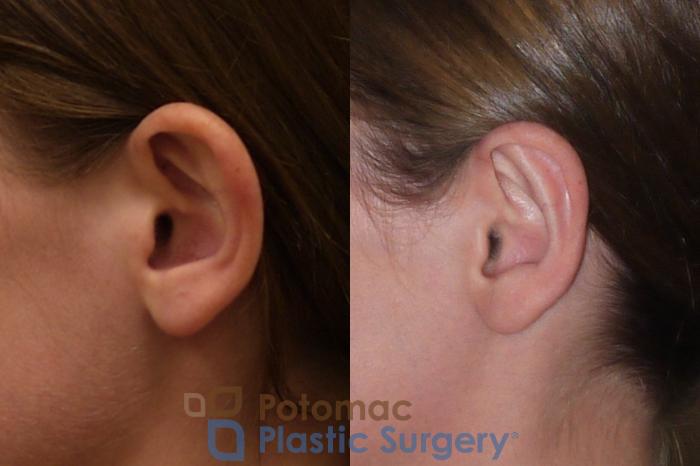 Before & After Otoplasty Case 150 Left Side View in Washington DC & Arlington , DC