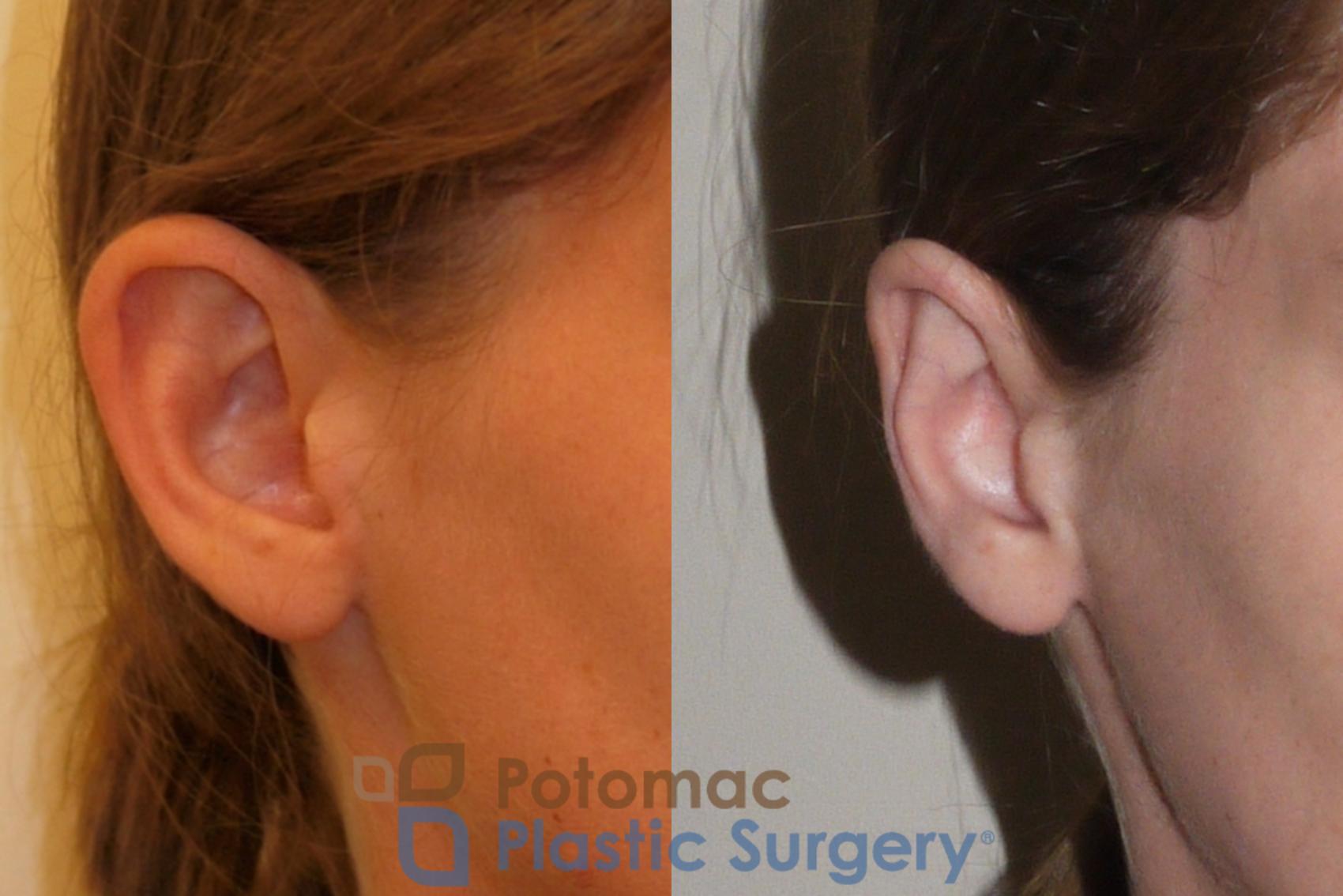 Before & After Otoplasty Case 150 Right Oblique View in Washington DC & Arlington , DC