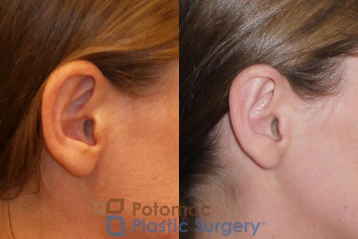 Before & After Otoplasty Case 150 Right Side View in Washington DC & Arlington , DC
