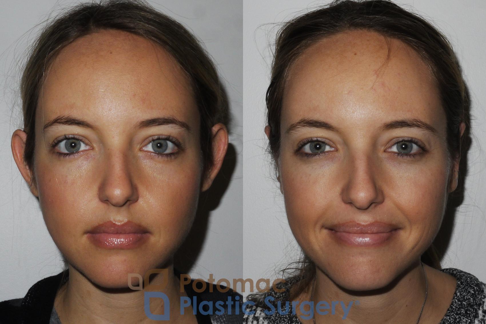 Before & After Otoplasty Case 166 Front View in Washington, DC