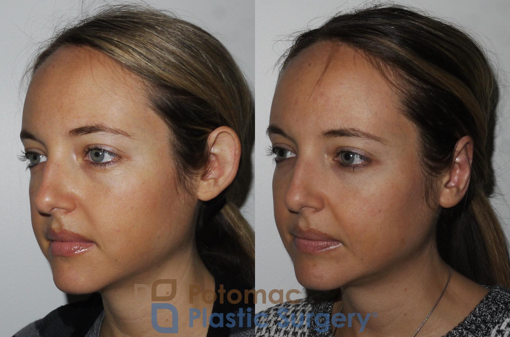 Before & After Otoplasty Case 166 Left Oblique View in Washington, DC