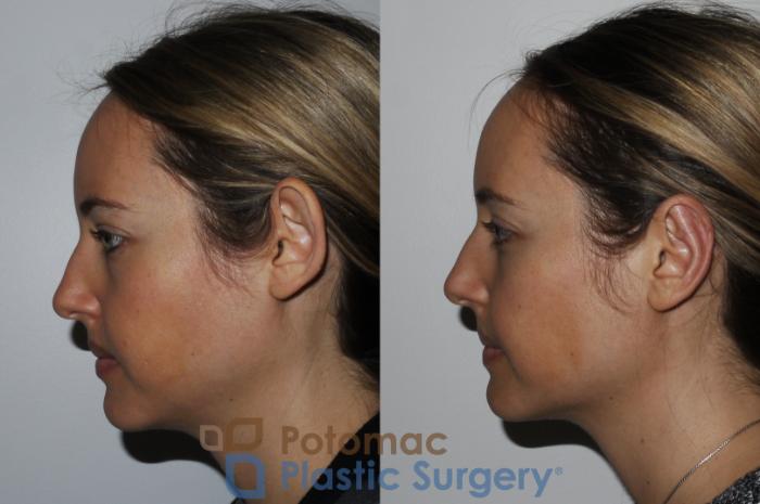 Before & After Otoplasty Case 166 Left Side View in Washington DC & Arlington , DC