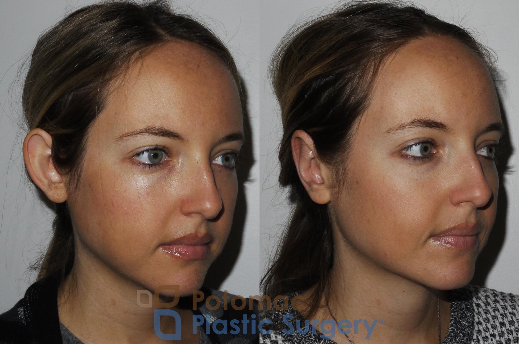 Before & After Otoplasty Case 166 Right Oblique View in Washington, DC