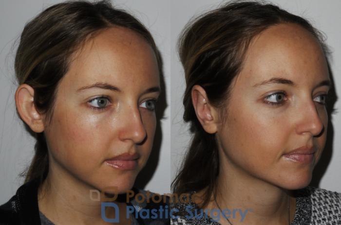 Before & After Otoplasty Case 166 Right Oblique View in Washington DC & Arlington , DC