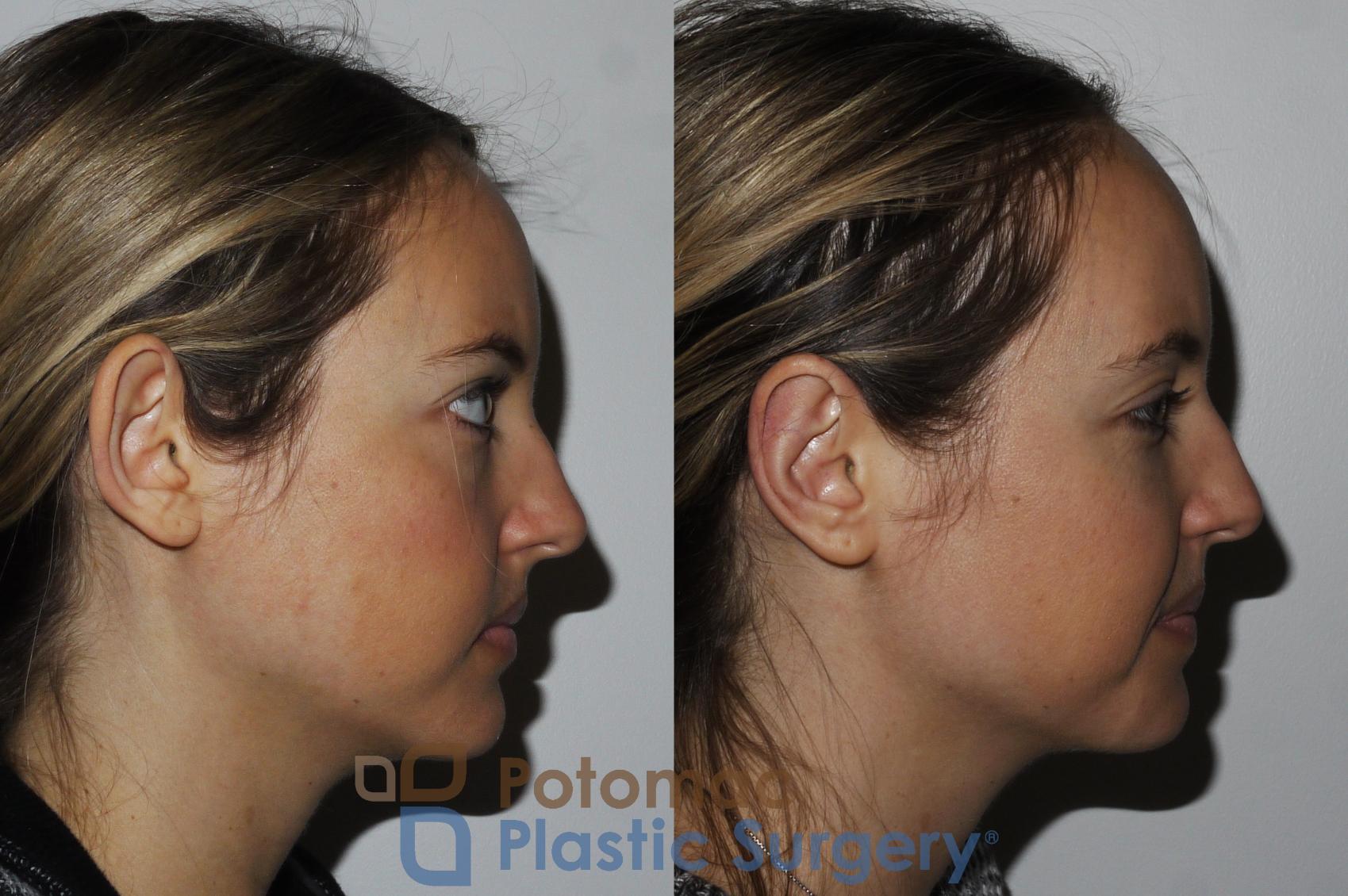 Before & After Otoplasty Case 166 Right Side View in Washington, DC