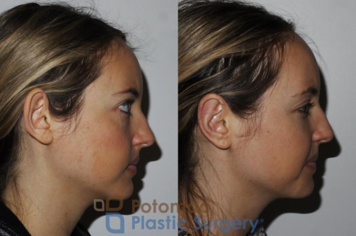 Before & After Otoplasty Case 166 Right Side View in Washington DC & Arlington , DC