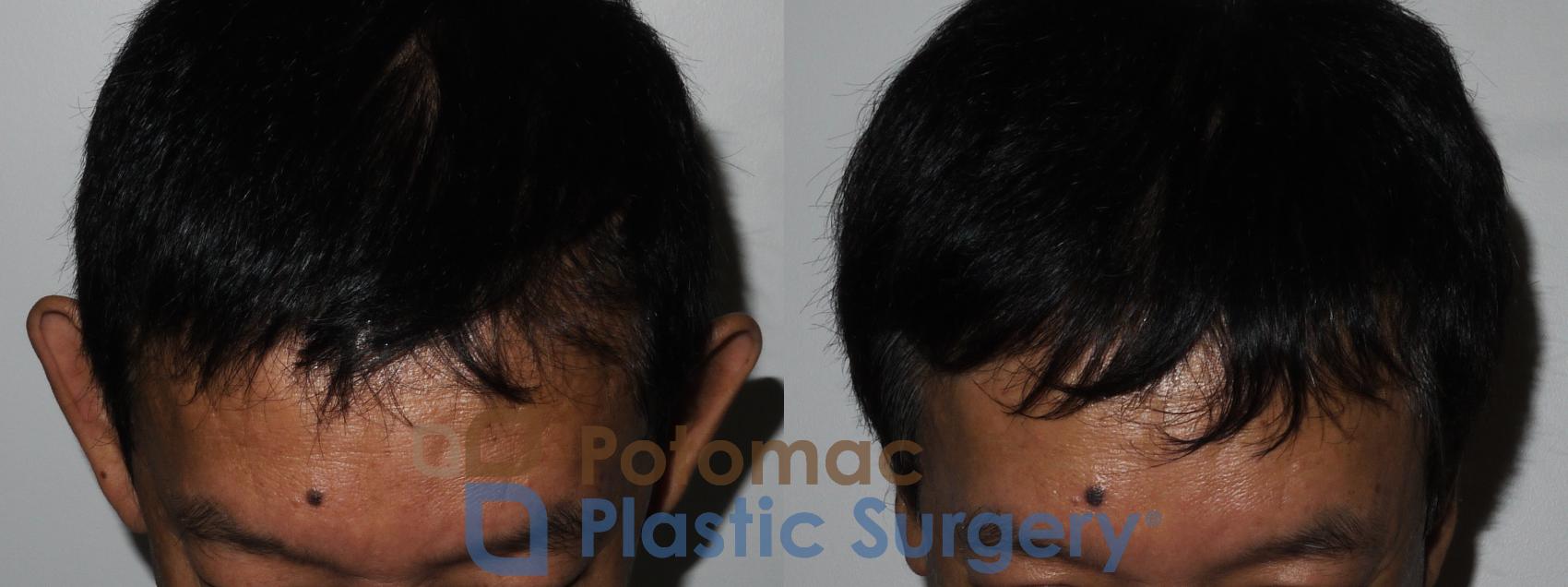 Before & After Otoplasty Case 183 Above View in Washington DC & Arlington , DC