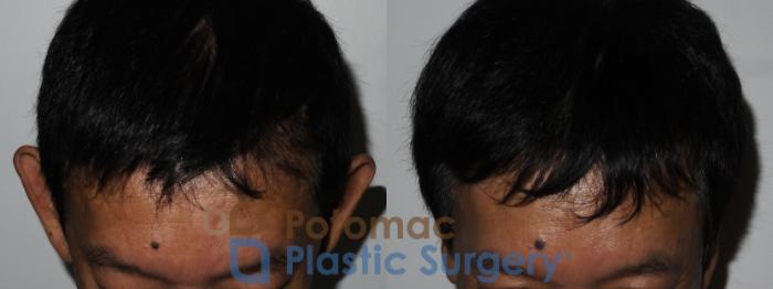 Before & After Otoplasty Case 183 Above View in Washington DC & Arlington , DC