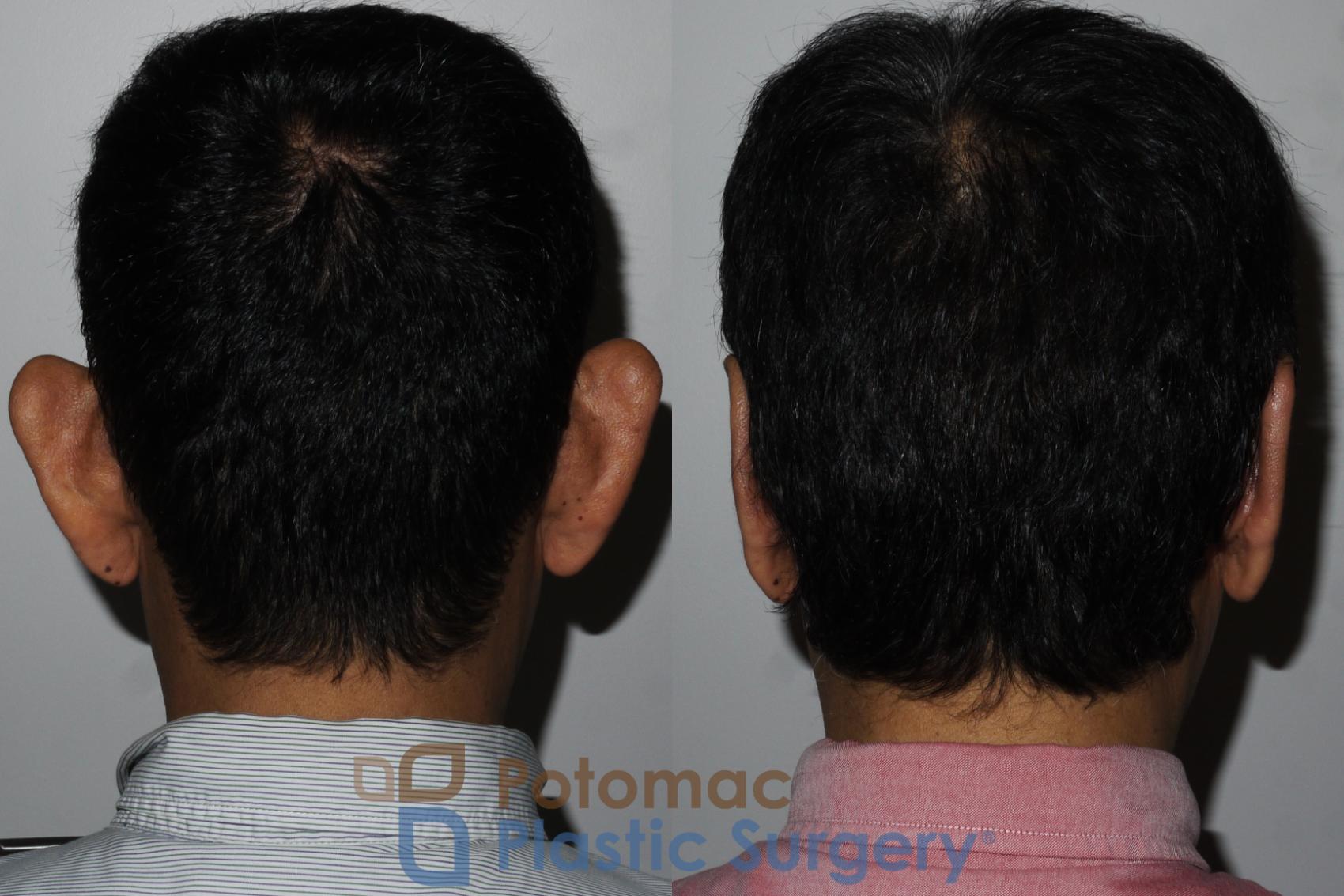 Before & After Otoplasty Case 183 Behind View in Washington, DC