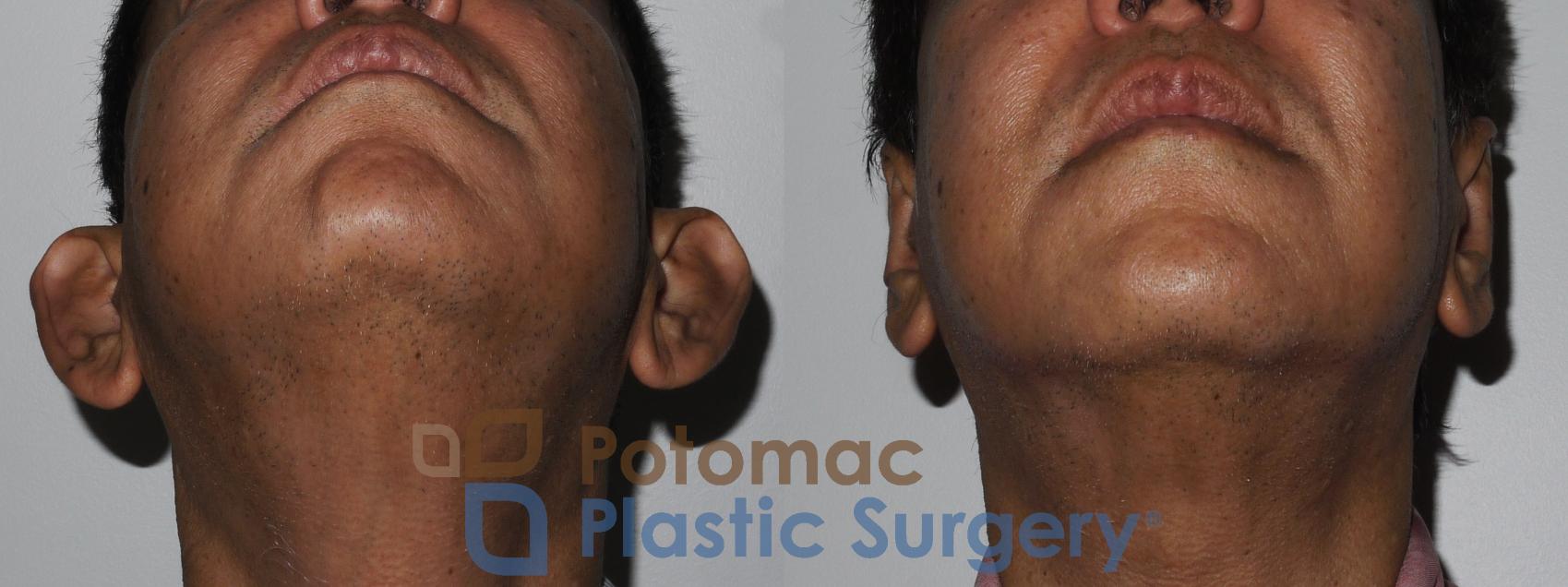 Before & After Otoplasty Case 183 Below View in Washington, DC