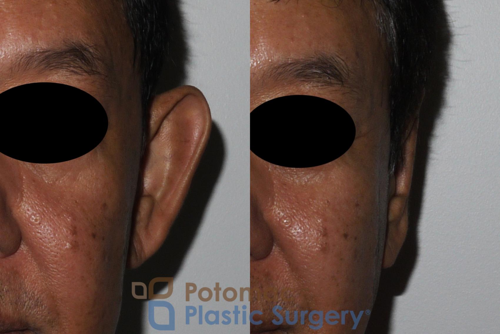 Before & After Otoplasty Case 183 Front View in Washington, DC