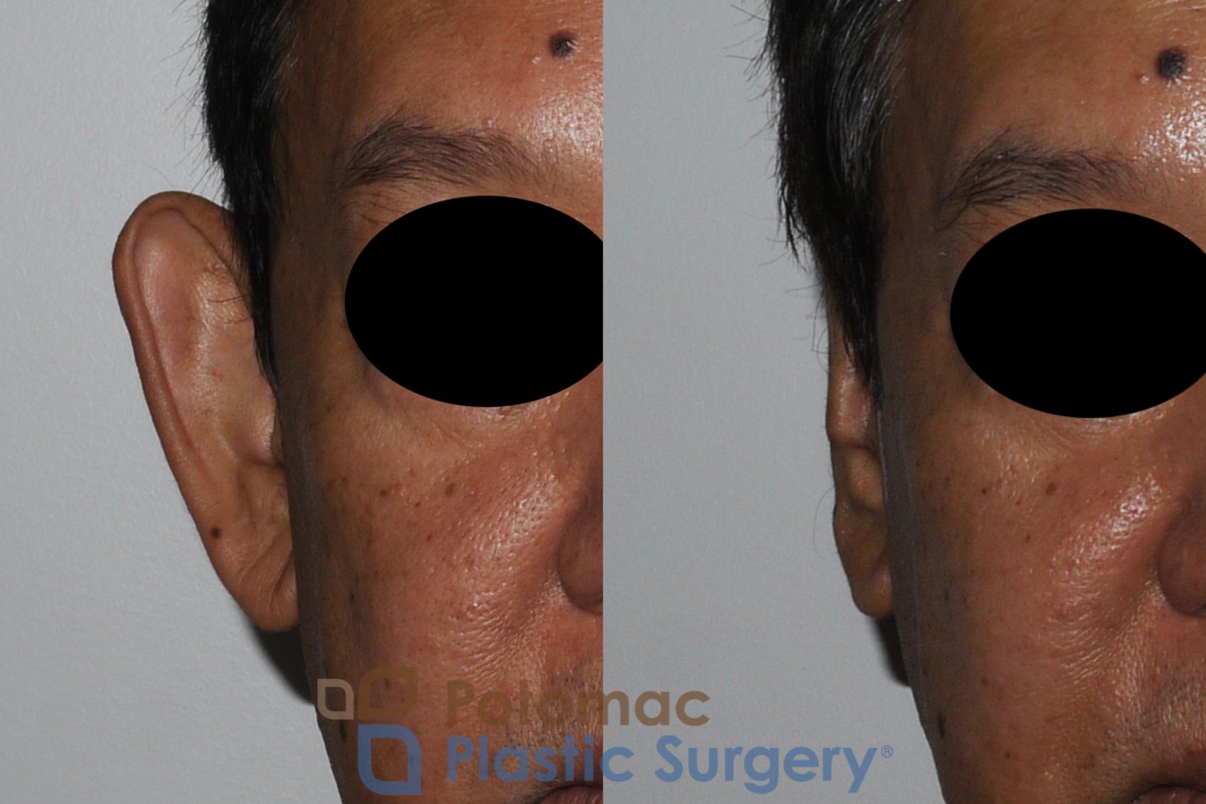 Before & After Otoplasty Case 183 Front View #2 View in Washington, DC