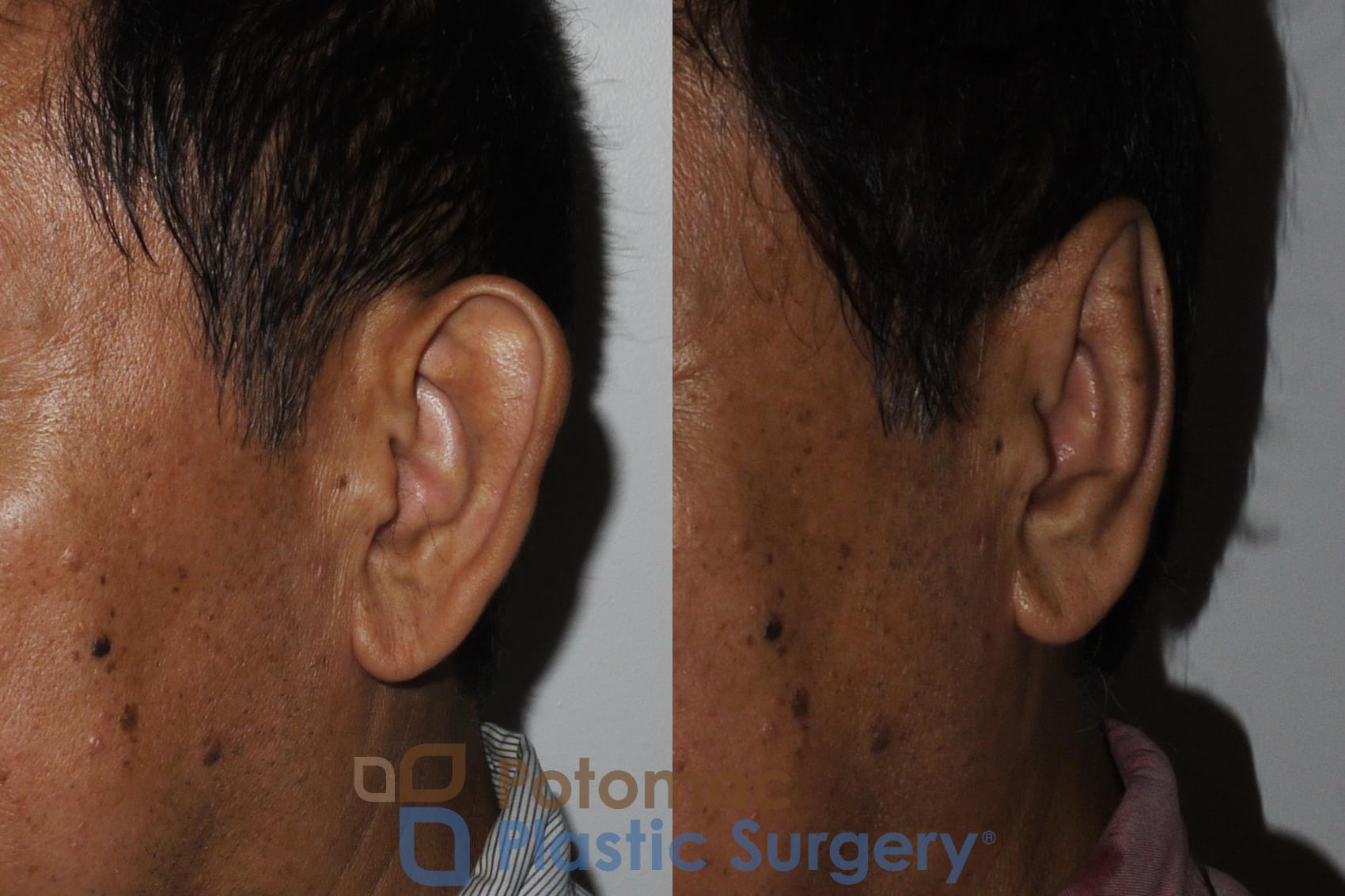 Before & After Otoplasty Case 183 Left Oblique View in Washington, DC