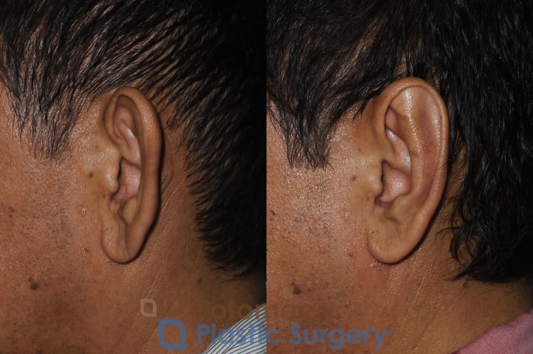 Before & After Otoplasty Case 183 Left Side View in Washington, DC
