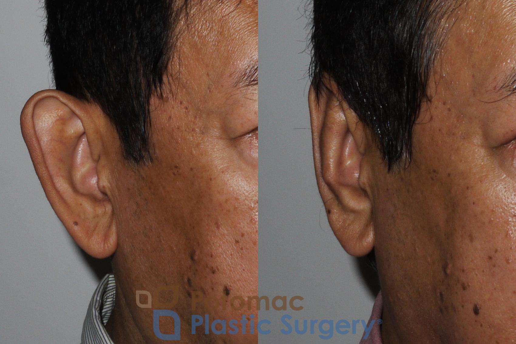 Before & After Otoplasty Case 183 Right Oblique View in Washington, DC