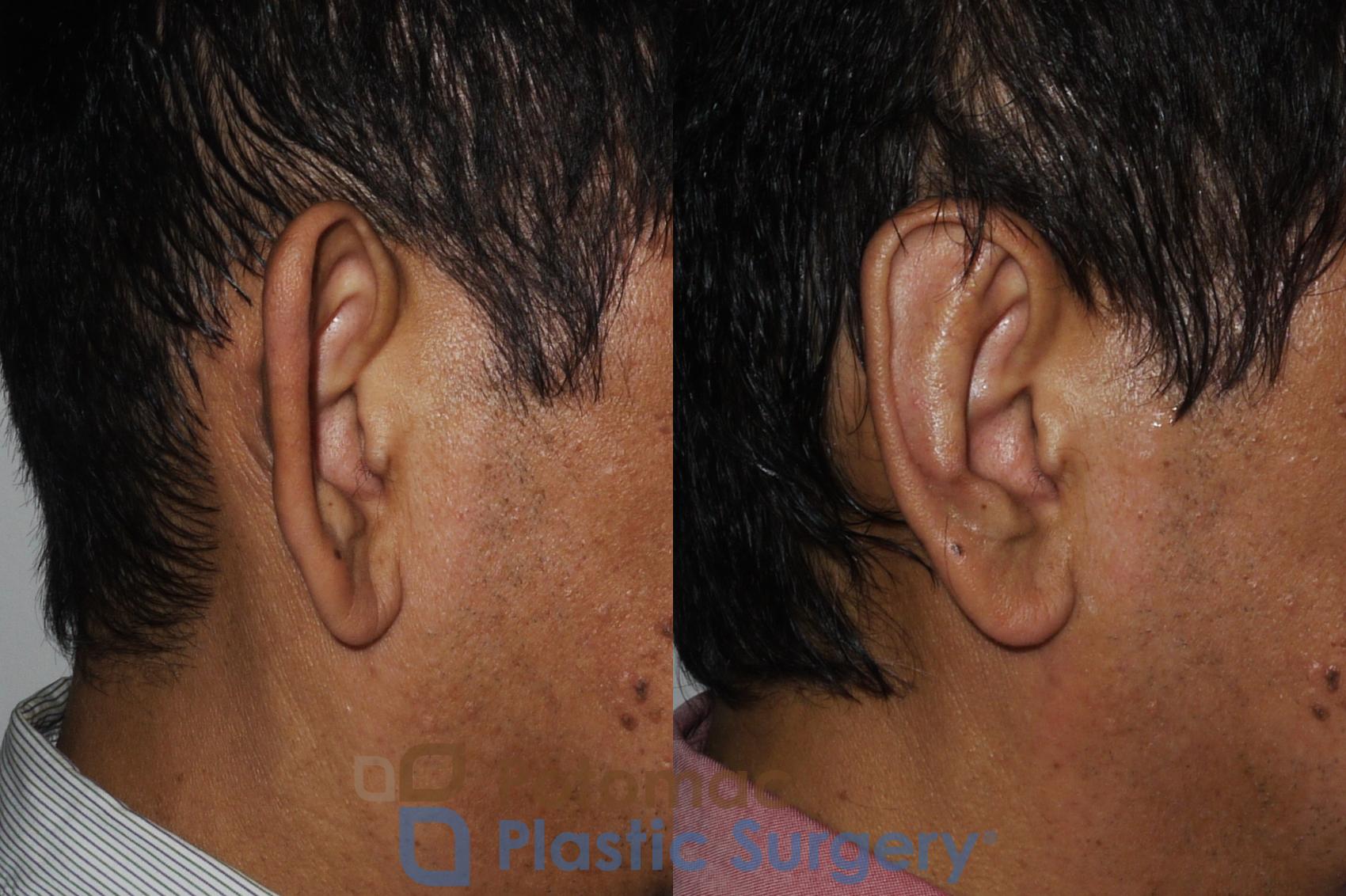 Before & After Otoplasty Case 183 Right Side View in Washington, DC