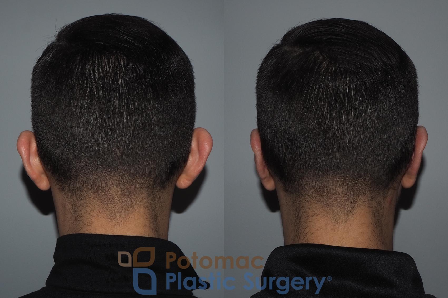 Before & After Otoplasty Case 217 Back View in Washington, DC