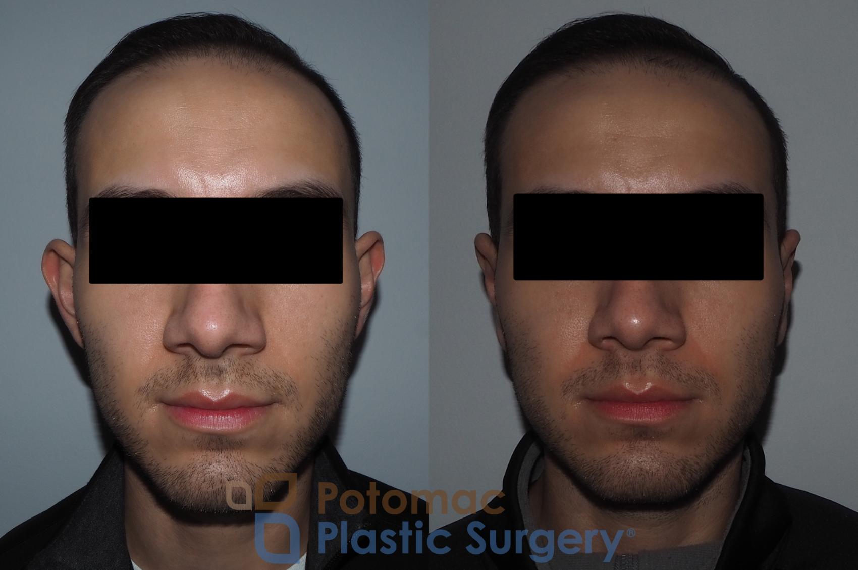 Before & After Otoplasty Case 217 Front View in Washington, DC