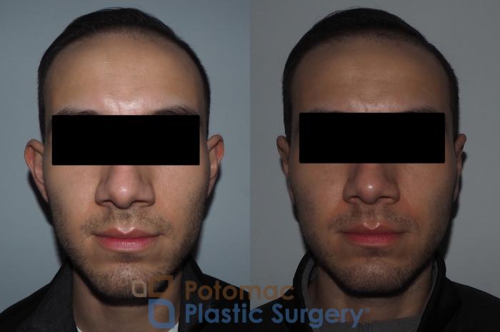 Before & After Otoplasty Case 217 Front View in Washington DC & Arlington , DC