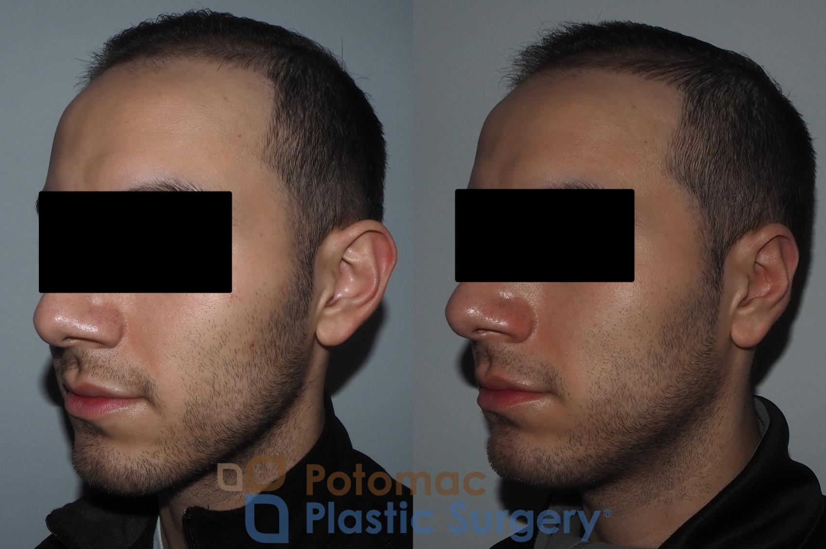 Before & After Otoplasty Case 217 Left Oblique View in Washington, DC