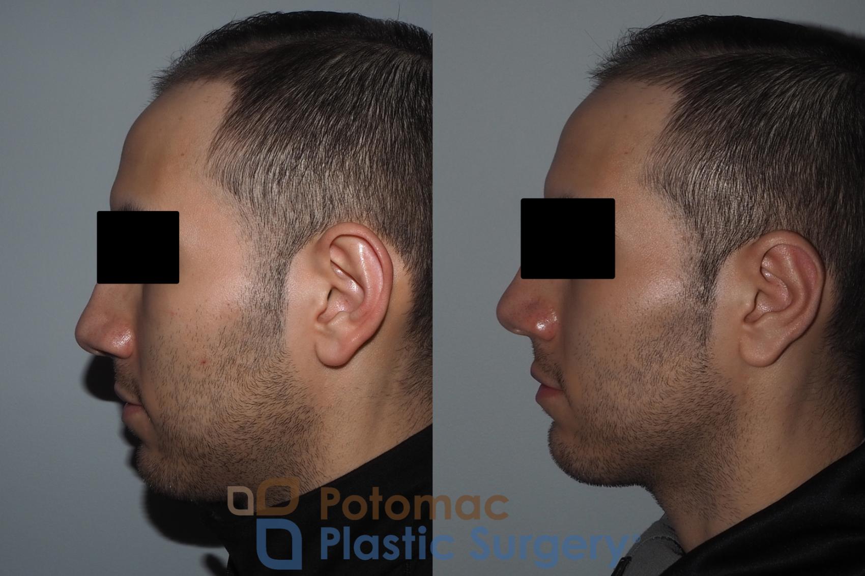 Otoplasty Before & After Photos Patient 217 