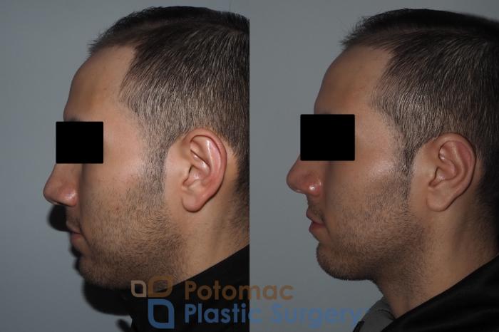 Before & After Otoplasty Case 217 Left Side View in Washington, DC