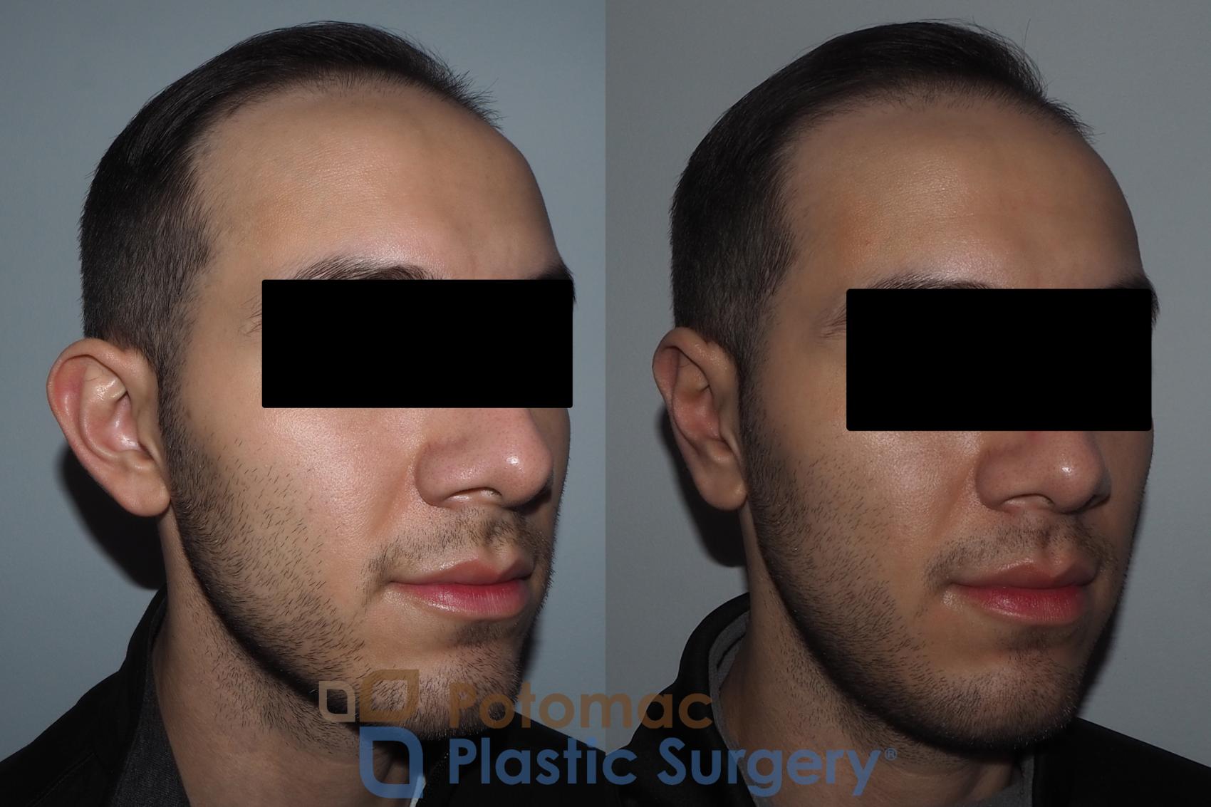 Before & After Otoplasty Case 217 Right Oblique View in Washington, DC