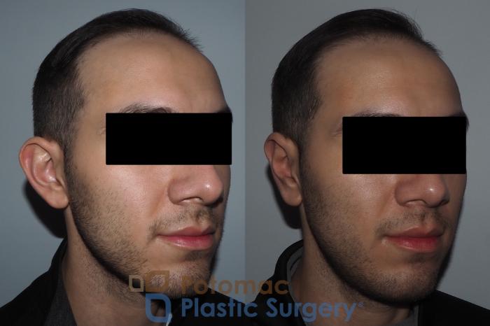 Before & After For Men Case 217 Right Oblique View in Washington DC & Arlington , DC